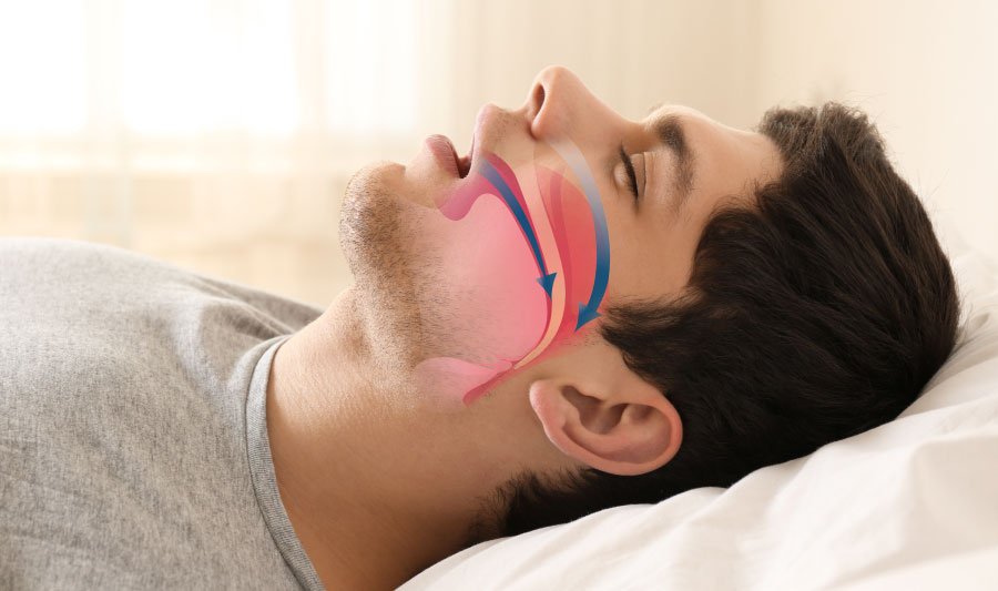 Snoring Treatment Bellingham and Snohomish